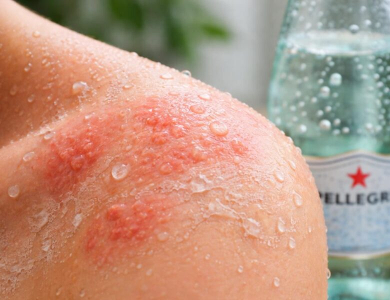 Les effets secondaires potentiels de l&rsquo;eau San Pellegrino sur votre peau