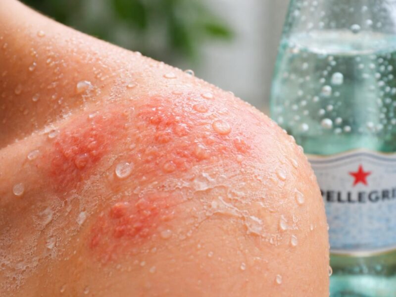 Les effets secondaires potentiels de l&rsquo;eau San Pellegrino sur votre peau